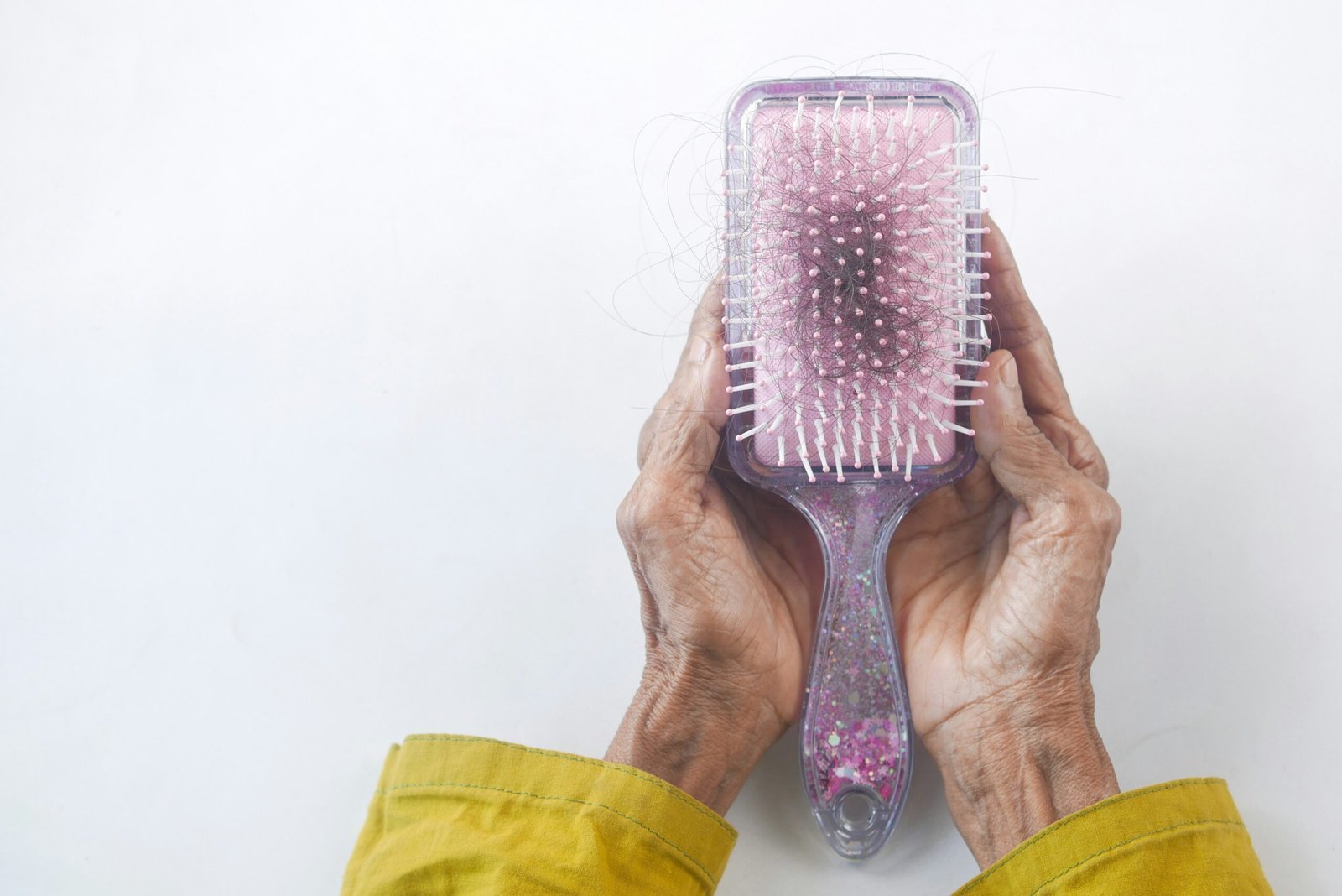 uma pessoa segurando uma escova de cabelo, cheio de cabelo nas mãos. Queda de cabelo