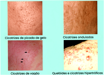 como tirar buraco de espinha do rosto