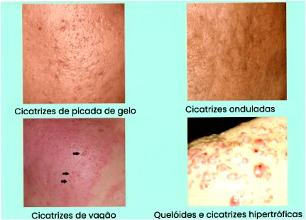 como tirar buraco de espinha do rosto